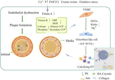 The role of extracellular vesicles in vascular calcification in chronic kidney disease